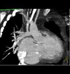 Patent B-t, Blalock Taussig, Shunt- See Full Sequence - CTisus CT Scan