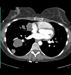 Metastatic Melanoma Involves Right Atrium - CTisus CT Scan