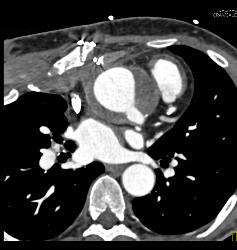 Root Repair With Reimplantation of Coronary Artery and Leak Presented as A Chest Wall Mass - CTisus CT Scan