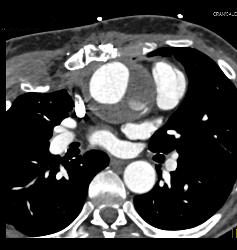 Root Repair With Reimplantation of Coronary Artery and Leak Presented as A Chest Wall Mass - CTisus CT Scan