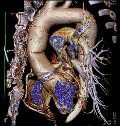 Root Repair With Reimplantation of Coronary Artery and Leak Presented as A Chest Wall Mass - CTisus CT Scan