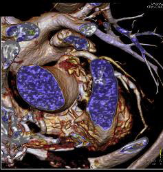 Root Repair With Reimplantation of Coronary Artery and Leak Presented as A Chest Wall Mass - CTisus CT Scan