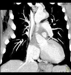 Root Repair With Reimplantation of Coronary Artery and Leak Presented as A Chest Wall Mass - CTisus CT Scan