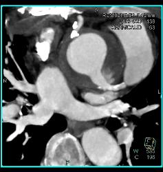 Root Repair With Reimplantation of Coronary Artery and Leak Presented as A Chest Wall Mass - CTisus CT Scan