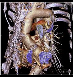 Root Repair With Reimplantation of Coronary Artery and Leak Presented as A Chest Wall Mass - CTisus CT Scan