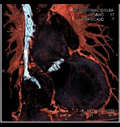 Aortic Valve Replacement (AVR) in 3D - CTisus CT Scan