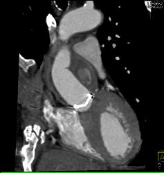 Aortic Valve Replacement (AVR) in 3D - CTisus CT Scan