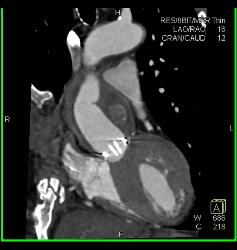 Aortic Valve Replacement (AVR) in 3D - CTisus CT Scan