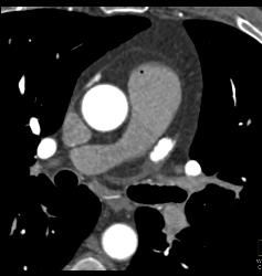 Good Timing for Aortic Root Study - CTisus CT Scan