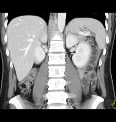 Pleural Implants - CTisus CT Scan