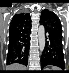 Pulmonary Embolism - Right Lower Lobe - CTisus CT Scan