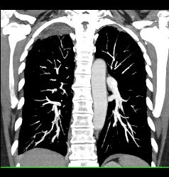 Pulmonary Embolism - Right Lower Lobe - CTisus CT Scan