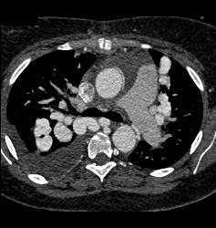 Incredible Pulmonary Vascular Malformation - CTisus CT Scan