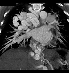 Incredible Pulmonary Vascular Malformation - CTisus CT Scan