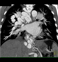 Incredible Pulmonary Vascular Malformation - CTisus CT Scan