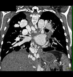 Incredible Pulmonary Vascular Malformation - CTisus CT Scan