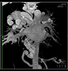 Incredible Pulmonary Vascular Malformation - CTisus CT Scan