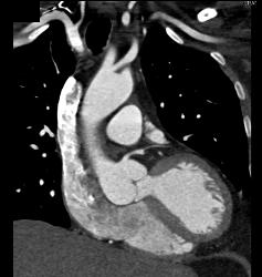 Dilated Aortic Root and Nice Left Atrial Appendage - CTisus CT Scan