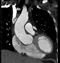 Dilated Aortic Root and Nice Left Atrial Appendage - CTisus CT Scan