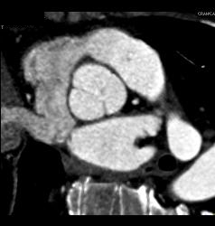 Normal Aortic Valve - CTisus CT Scan