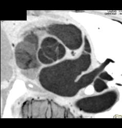 Normal Aortic Valve - CTisus CT Scan