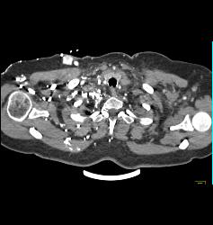 SVC Occlusion With Collaterals. SVC Occlusion Was Due to Tumor - CTisus CT Scan