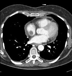 SVC Occlusion With Collaterals. SVC Occlusion Was Due to Tumor - CTisus CT Scan