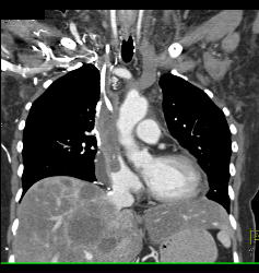 SVC Occlusion With Collaterals. SVC Occlusion Was Due to Tumor - CTisus CT Scan