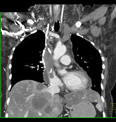 SVC Occlusion With Collaterals. SVC Occlusion Was Due to Tumor - CTisus CT Scan