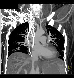 SVC Occlusion With Collaterals. SVC Occlusion Was Due to Tumor - CTisus CT Scan