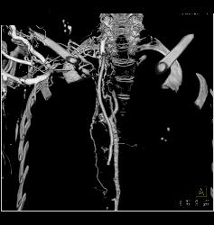 SVC Occlusion With Collaterals. SVC Occlusion Was Due to Tumor - CTisus CT Scan