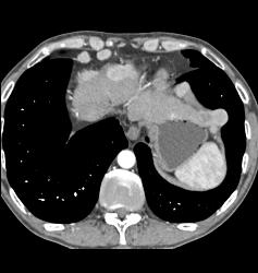 Para-cardiac Nodes in A Carcinoid Patient - CTisus CT Scan