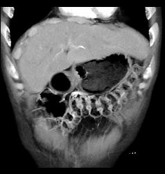 Para-cardiac Nodes in A Carcinoid Patient - CTisus CT Scan