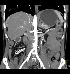 Para-cardiac Nodes in A Carcinoid Patient - CTisus CT Scan