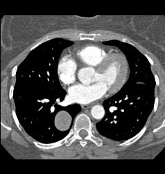 Hamartoma - CTisus CT Scan