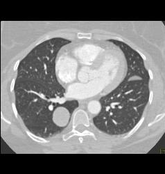 Hamartoma - CTisus CT Scan