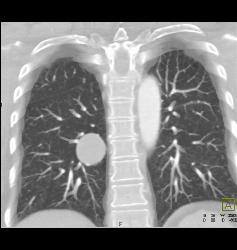 Hamartoma - CTisus CT Scan