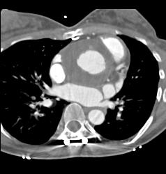 Aortic Root Repair With Fluid - CTisus CT Scan