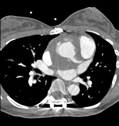 Aortic Root Repair With Fluid - CTisus CT Scan