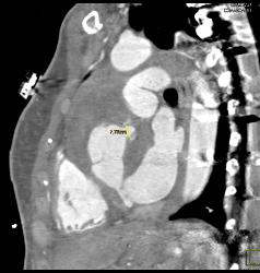 Aortic Root Repair With Fluid - CTisus CT Scan