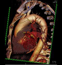 3D Relationship of Arch Vessels to Trachea - CTisus CT Scan