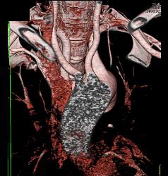 3D Relationship of Arch Vessels to Trachea - CTisus CT Scan