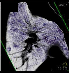 3D Relationship of Arch Vessels to Trachea - CTisus CT Scan