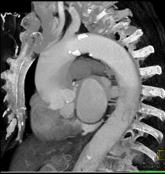 Dilated Ascending Aorta With Aortic Valve Calcifications- Leads to Aortic Stenosis - CTisus CT Scan