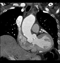 Dilated Ascending Aorta With Aortic Valve Calcifications- Leads to Aortic Stenosis - CTisus CT Scan