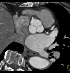 Dilated Ascending Aorta With Aortic Valve Calcifications- Leads to Aortic Stenosis - CTisus CT Scan