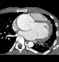 Dilated Sinus of Valsalva in Marfan Syndrome Patient - CTisus CT Scan