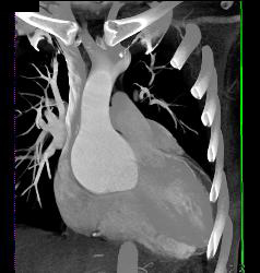 Dilated Sinus of Valsalva in Marfan Syndrome Patient - CTisus CT Scan