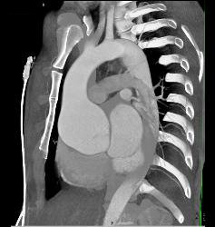 Dilated Sinus of Valsalva in Marfan Syndrome Patient - CTisus CT Scan