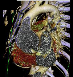 Dilated Sinus of Valsalva in Marfan Syndrome Patient - CTisus CT Scan